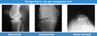 Ontlasting gewricht helpt bij artrose